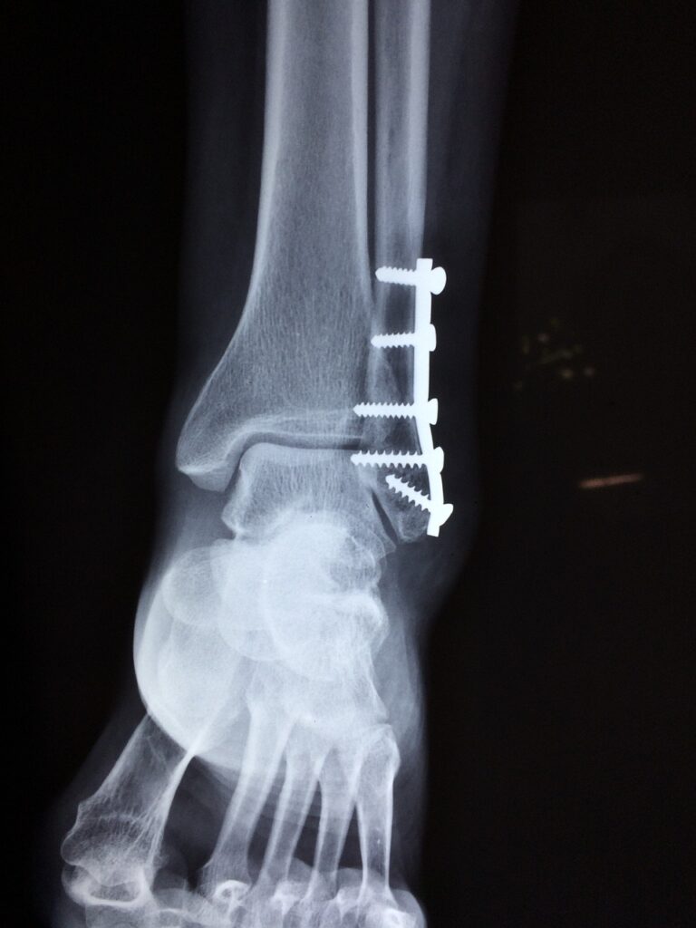 x-ray image of an ankle